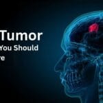 Brain Tumor Symptoms You Should Never Ignore Prothomesta
